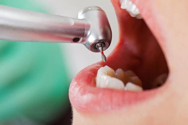 Best Emergency Tooth Extraction in Maroa, IL